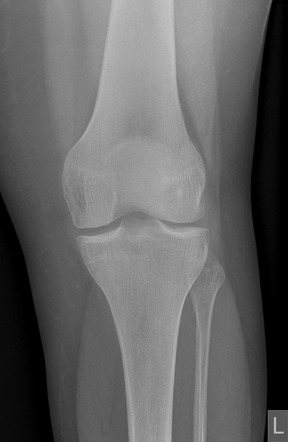 Osteochondritis dissecans - lateral femoral trochlea | Image ...