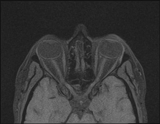 Idiopathic intracranial hypertension | Image | Radiopaedia.org