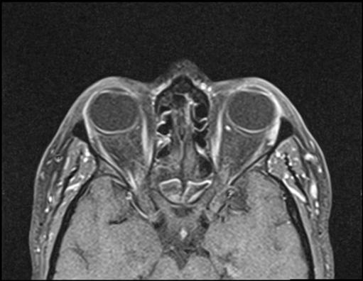 Idiopathic Intracranial Hypertension Image 6248