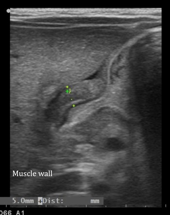 Congenital Hypertrophic Pyloric Stenosis Radiology Case Radiopaedia Org