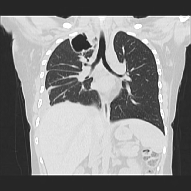 Cerebral tuberculoma | Image | Radiopaedia.org