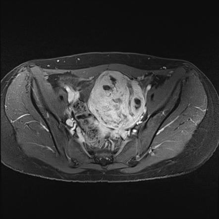 Rhabdomyosarcoma (genitourinary tract) | Radiology Reference Article