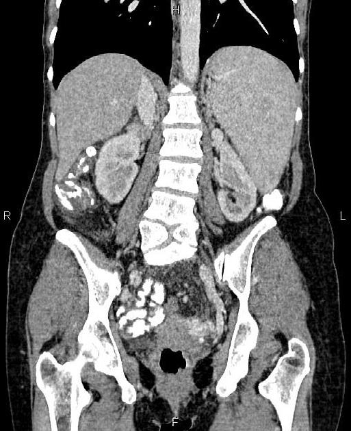 Butterfly vertebra | Radiology Reference Article | Radiopaedia.org