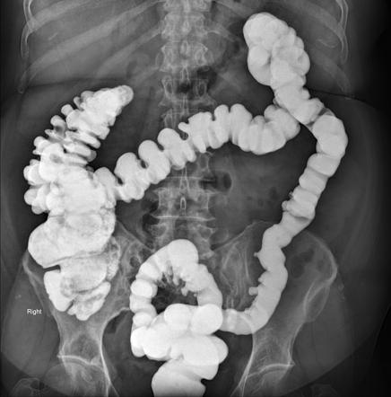 Colon diverticulosis (barium study) | Radiology Case | Radiopaedia.org