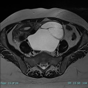 Ovarian serous cystadenoma | Radiology Reference Article | Radiopaedia.org