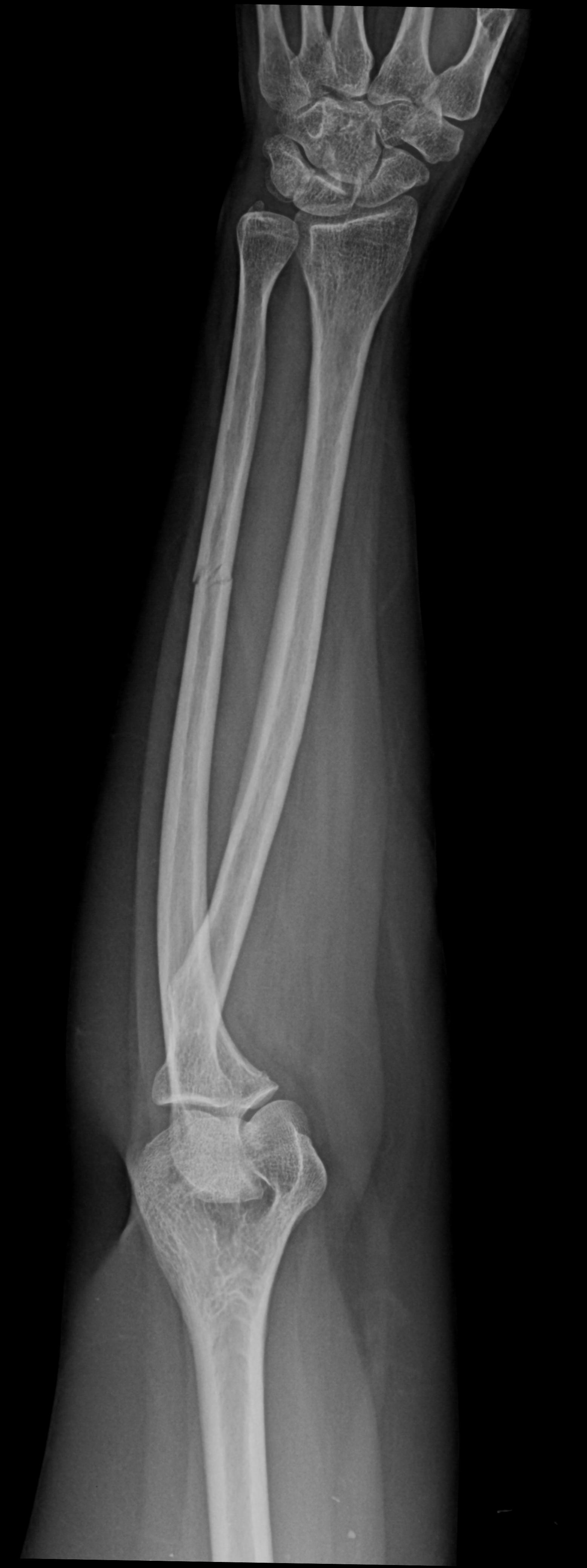 Isolated Ulna Shaft Fracture Image Radiopaedia Org