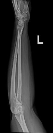 Isolated Ulna Shaft Fracture Image Radiopaedia Org