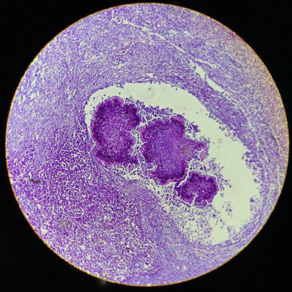 Maduromycosis of foot | Image | Radiopaedia.org