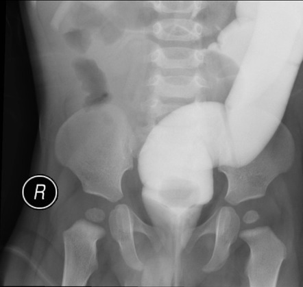 Intussusception | Image | Radiopaedia.org