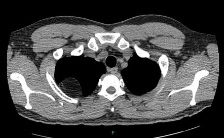 Parietal pleural lipoma | Radiology Case | Radiopaedia.org