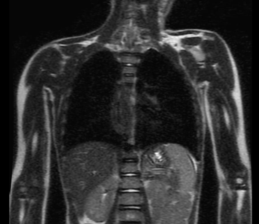 Esophageal leiomyomatosis | Image | Radiopaedia.org