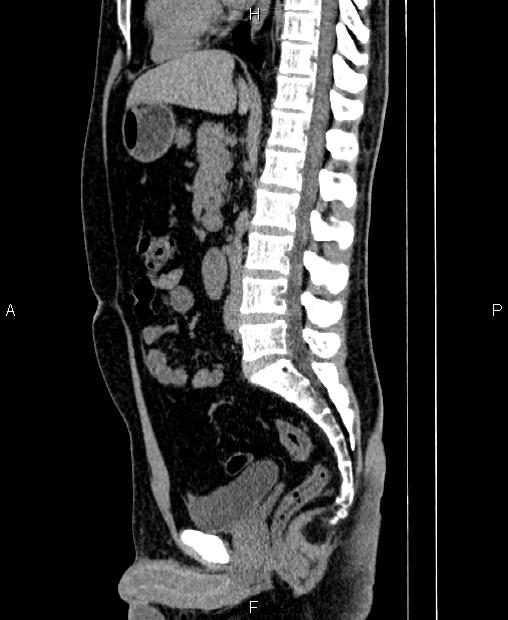 Horseshoe kidneys Image