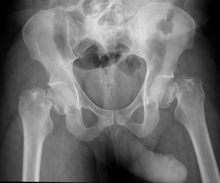 Neck of femur fracture | Radiology Reference Article | Radiopaedia.org