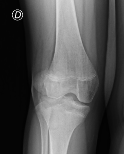 Osteochondral fracture post lateral patellar dislocation | Image ...