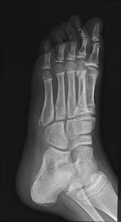 Apophysis of the fifth metatarsal | Radiology Case | Radiopaedia.org