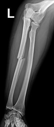 Isolated Ulna Shaft Fracture Radiology Case Radiopaedia Org