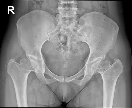 Craniometaphyseal dysplasia radiology