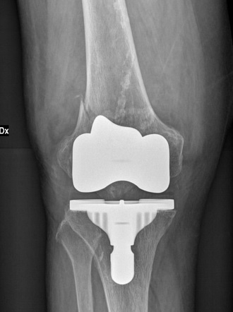 Total knee arthroplasty periprosthetic fracture - type II Lewis and ...