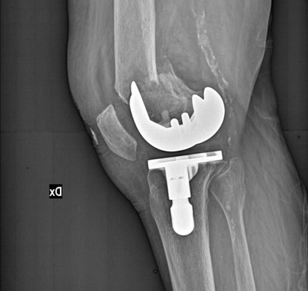 Total knee arthroplasty periprosthetic fracture - type II Lewis and ...