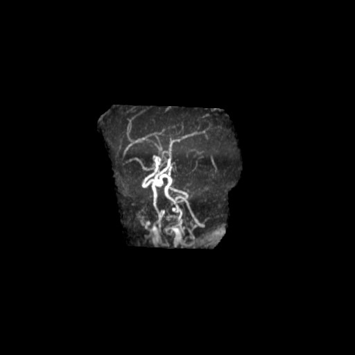 Arterial Tortuosity Syndrome Image Radiopaedia Org