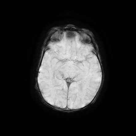 Arterial Tortuosity Syndrome Image Radiopaedia Org