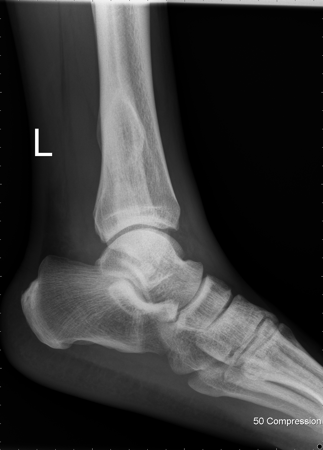 Distal Tibiofibular Syndesmosis Ossification (tfso) 