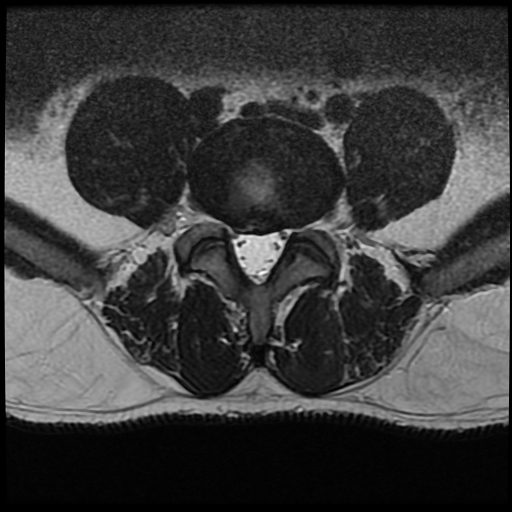 Foraminal zone disc extrusion | Image | Radiopaedia.org