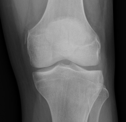 Pellegrini-Stieda lesion | Radiology Case | Radiopaedia.org