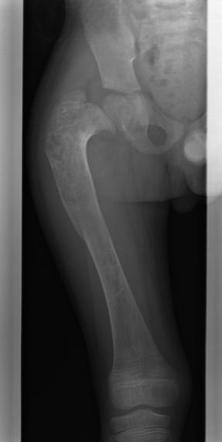 Shepherd's crook deformity in fibrous dysplasia | Image