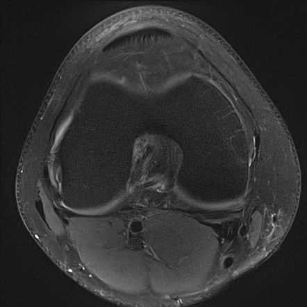 Semimembranosus injury - distal (knee MRI) | Image | Radiopaedia.org