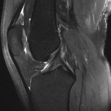 Semimembranosus injury - distal (knee MRI) | Image | Radiopaedia.org