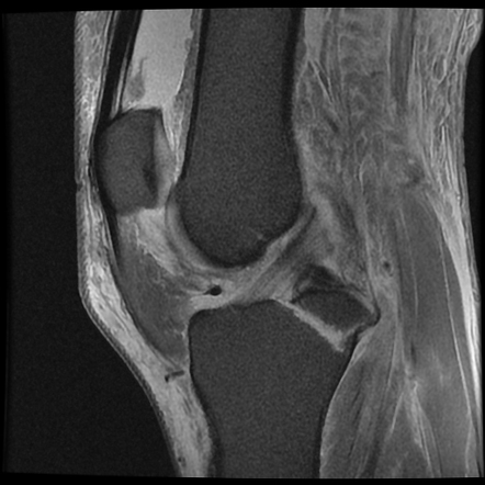 Posterior cruciate ligament avulsion fracture | Image | Radiopaedia.org