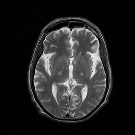 Amyotrophic lateral sclerosis (ALS) | Image | Radiopaedia.org