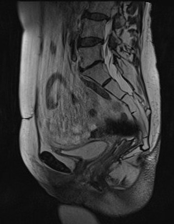 Rectovaginal fistula (MRI enema) | Image | Radiopaedia.org