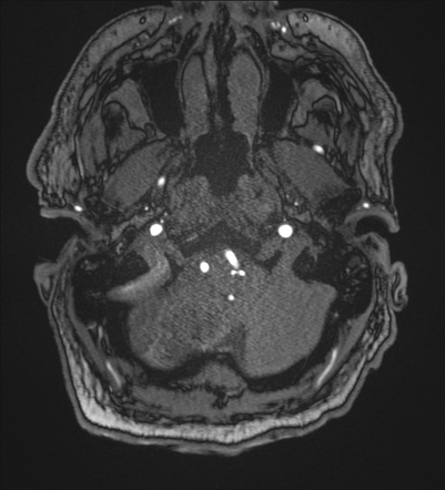 Subacute posterior inferior cerebellar artery infarct | Image ...