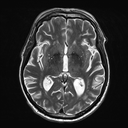 Subacute posterior inferior cerebellar artery infarct | Image ...