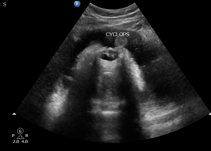 Cyclopia with proboscis | Image | Radiopaedia.org