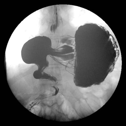 Intestinal volvulus | Radiology Reference Article | Radiopaedia.org