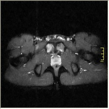 Osteitis pubis | Image | Radiopaedia.org