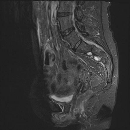 Rectal stump check for leak (MRI enema) | Image | Radiopaedia.org