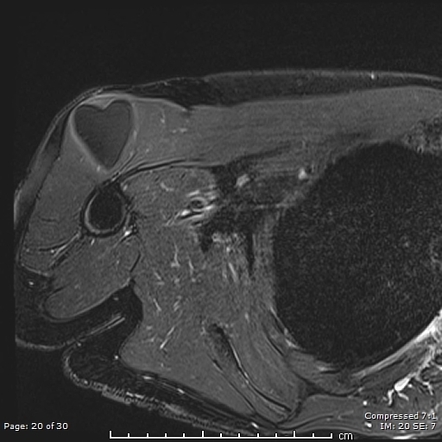 Intramuscular Lipoma Radiology Reference Article Radiopaedia Org