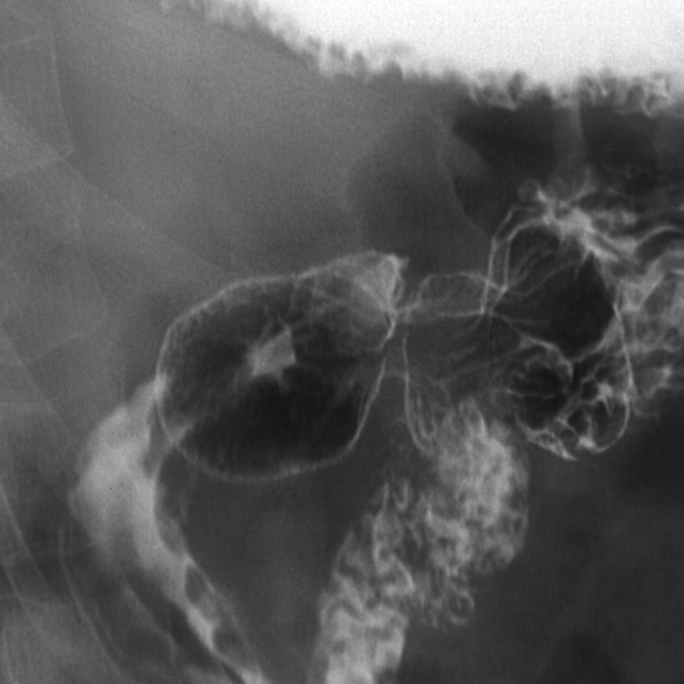 Antral ulcer | Image | Radiopaedia.org