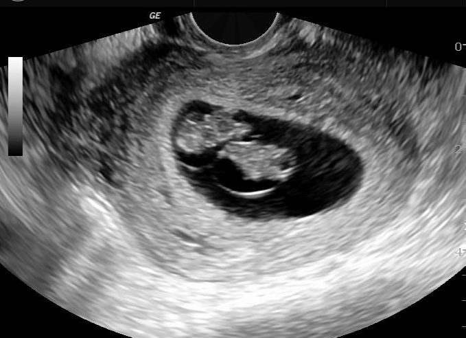 Monochorionic Diamniotic Twin Pregnancy Image