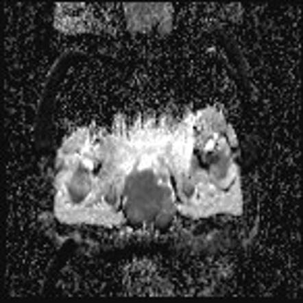 Embryonal rhabdomyosarcoma | Image | Radiopaedia.org