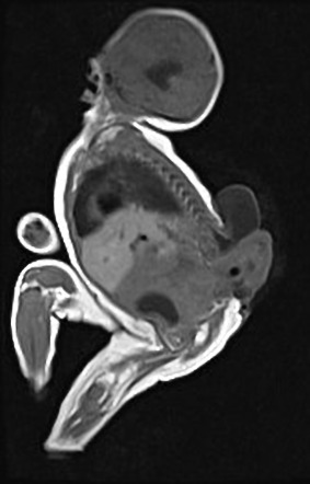 Split notochord syndrome | Image | Radiopaedia.org