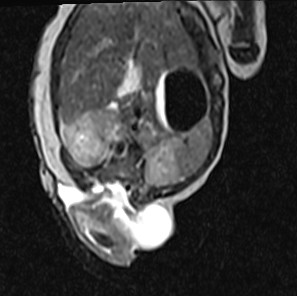 Split notochord syndrome | Image | Radiopaedia.org