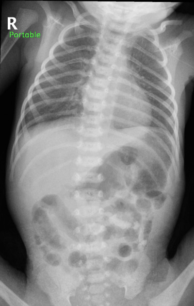 Duodenal Atresia X Ray