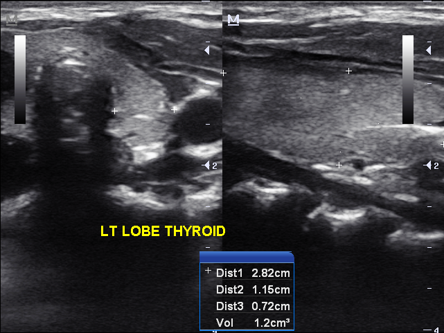 Partially cystic thyroid nodule - benign Hurthle changes | Image ...