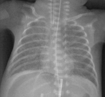 Pneumoperitoneum (neonate) | Radiology Case | Radiopaedia.org