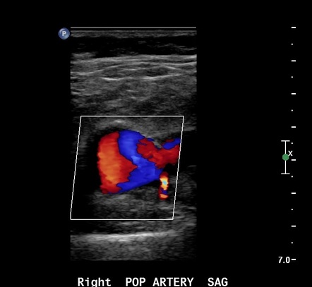 Popliteal artery aneurysm | Image | Radiopaedia.org